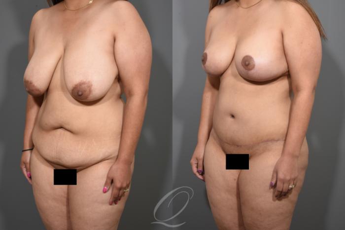 Tummy Tuck Case 346 Before & After View #4 | Serving Rochester, Syracuse & Buffalo, NY | Quatela Center for Plastic Surgery
