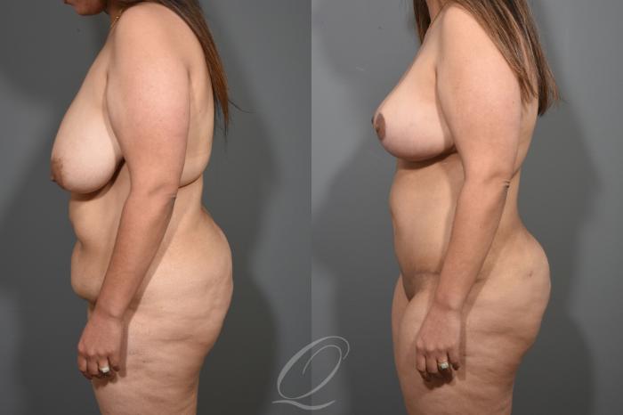 Breast Lift Case 346 Before & After View #5 | Serving Rochester, Syracuse & Buffalo, NY | Quatela Center for Plastic Surgery