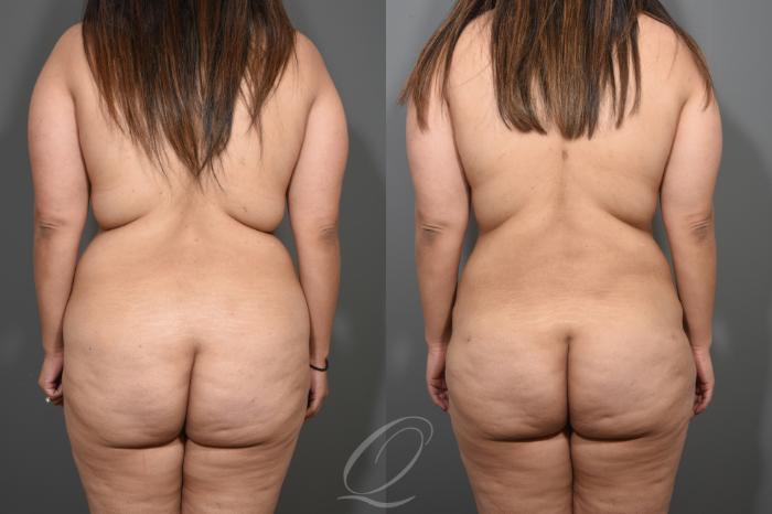 Mommy Makeover Case 346 Before & After View #6 | Serving Rochester, Syracuse & Buffalo, NY | Quatela Center for Plastic Surgery