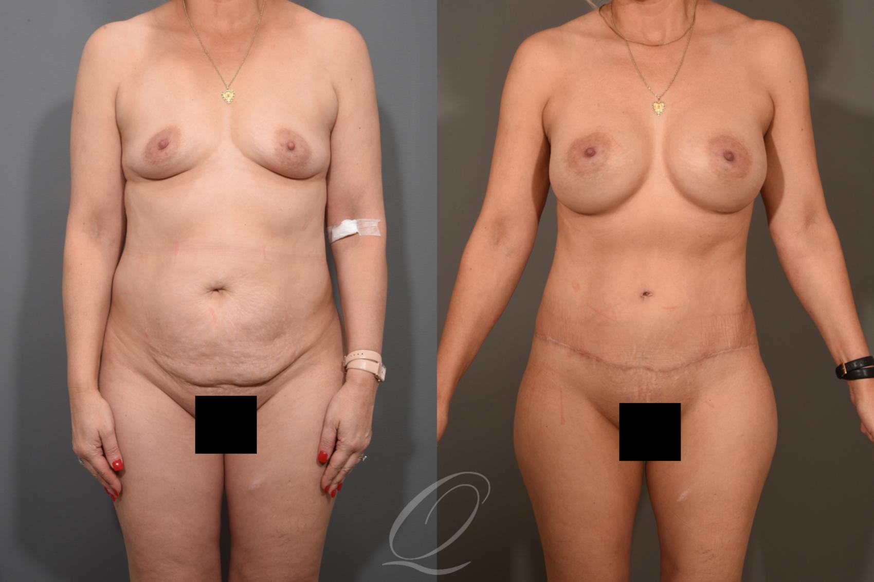 Mommy Makeover Case 381 Before & After View #1 | Serving Rochester, Syracuse & Buffalo, NY | Quatela Center for Plastic Surgery