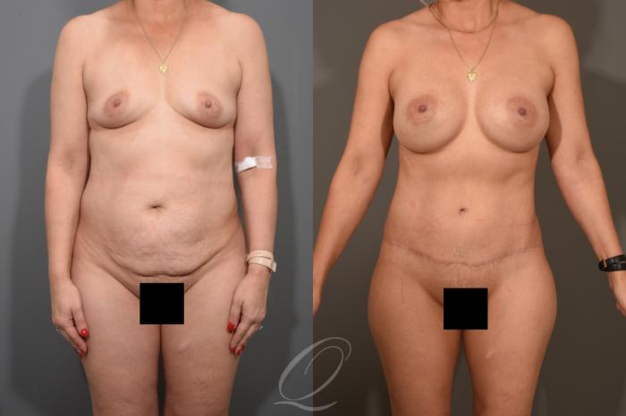 Breast Augmentation Case 381 Before & After View #1 | Serving Rochester, Syracuse & Buffalo, NY | Quatela Center for Plastic Surgery