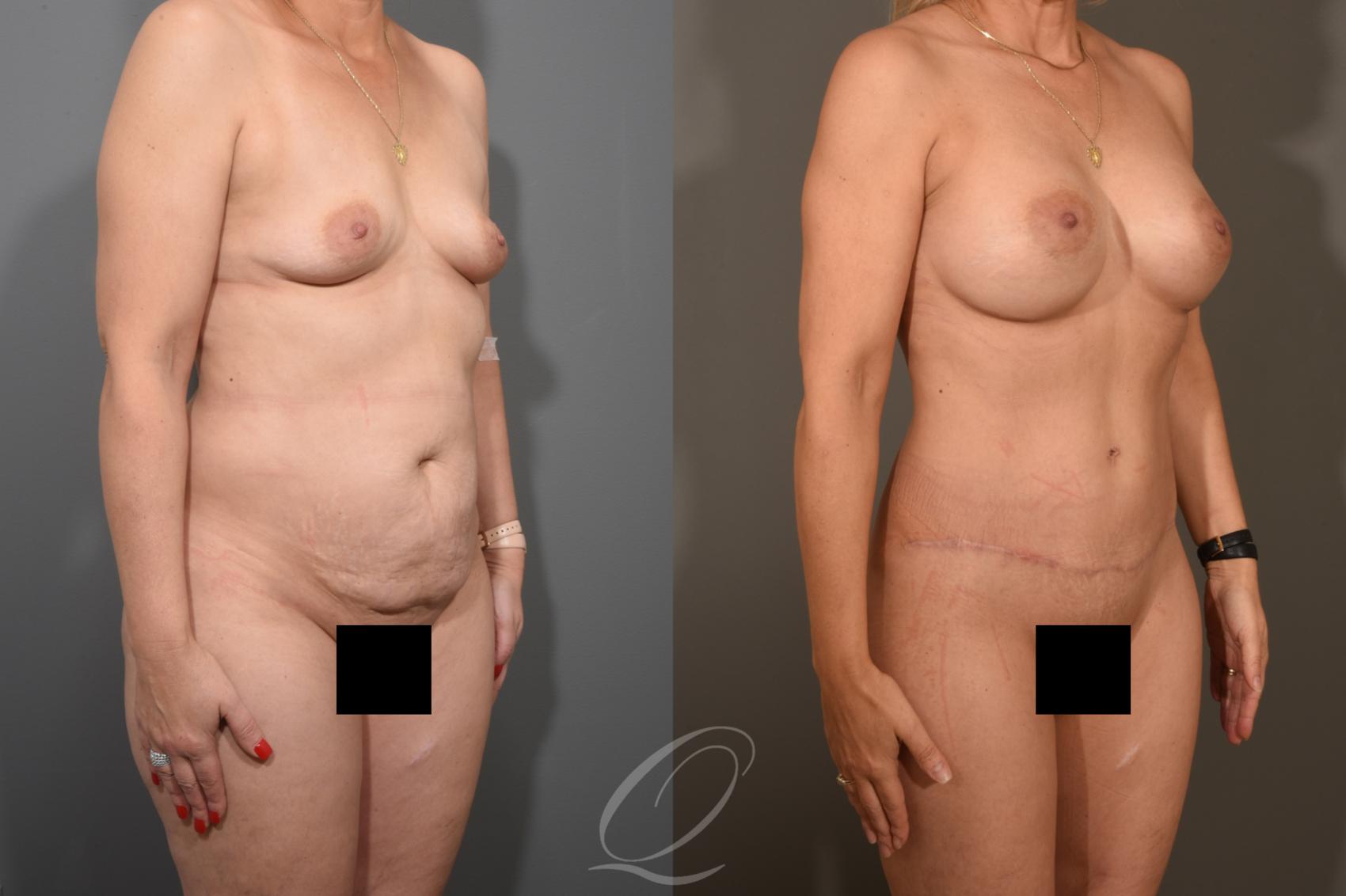 Mommy Makeover Case 381 Before & After View #2 | Serving Rochester, Syracuse & Buffalo, NY | Quatela Center for Plastic Surgery