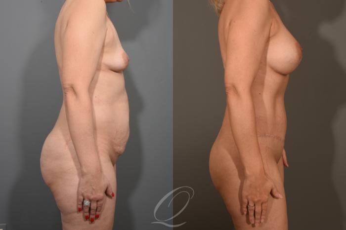 Breast Augmentation Case 381 Before & After View #3 | Serving Rochester, Syracuse & Buffalo, NY | Quatela Center for Plastic Surgery