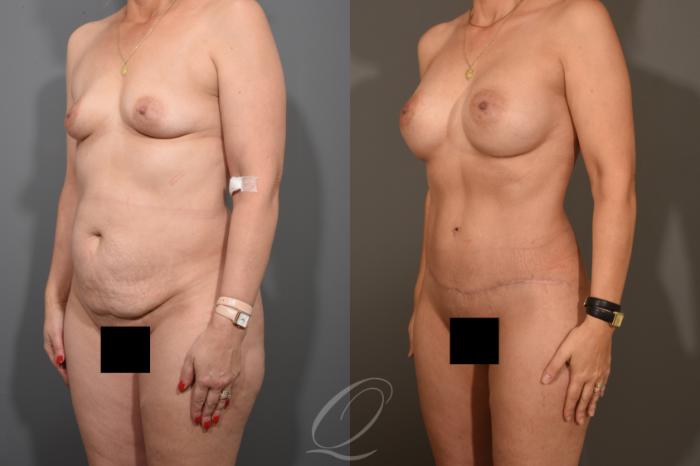 Breast Augmentation Case 381 Before & After View #4 | Serving Rochester, Syracuse & Buffalo, NY | Quatela Center for Plastic Surgery