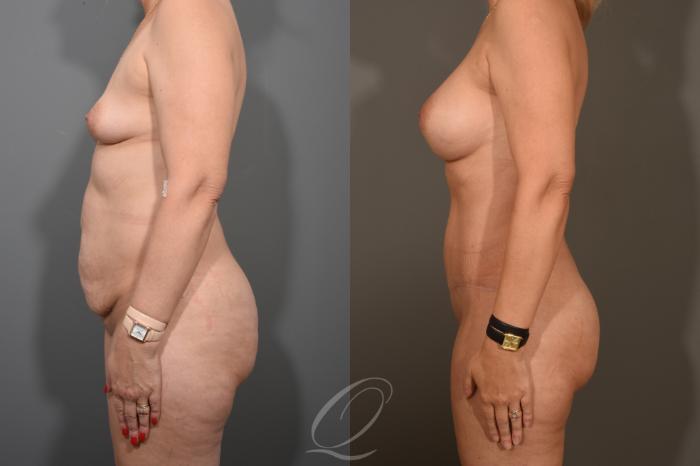 Breast Augmentation Case 381 Before & After View #5 | Serving Rochester, Syracuse & Buffalo, NY | Quatela Center for Plastic Surgery