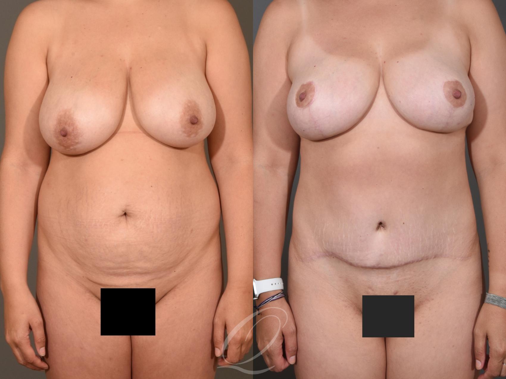 Breast Lift Case 395 Before & After Front | Serving Rochester, Syracuse & Buffalo, NY | Quatela Center for Plastic Surgery