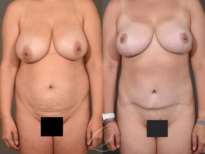Tummy Tuck Case 395 Before & After Front | Serving Rochester, Syracuse & Buffalo, NY | Quatela Center for Plastic Surgery