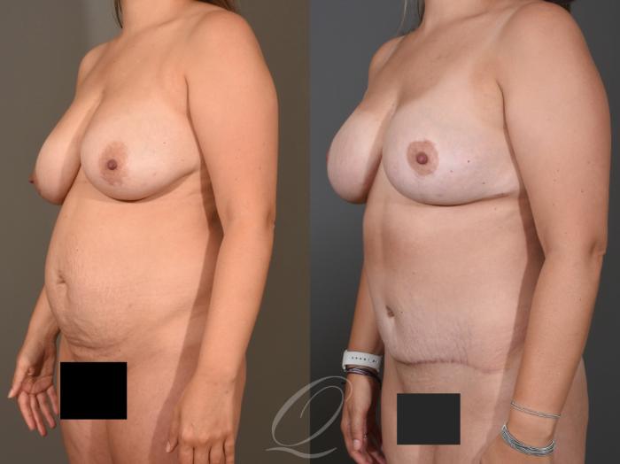 Tummy Tuck Case 395 Before & After Left Oblique | Serving Rochester, Syracuse & Buffalo, NY | Quatela Center for Plastic Surgery