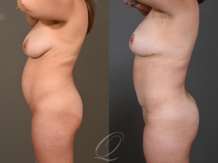 Mommy Makeover Case 395 Before & After Left Side | Serving Rochester, Syracuse & Buffalo, NY | Quatela Center for Plastic Surgery