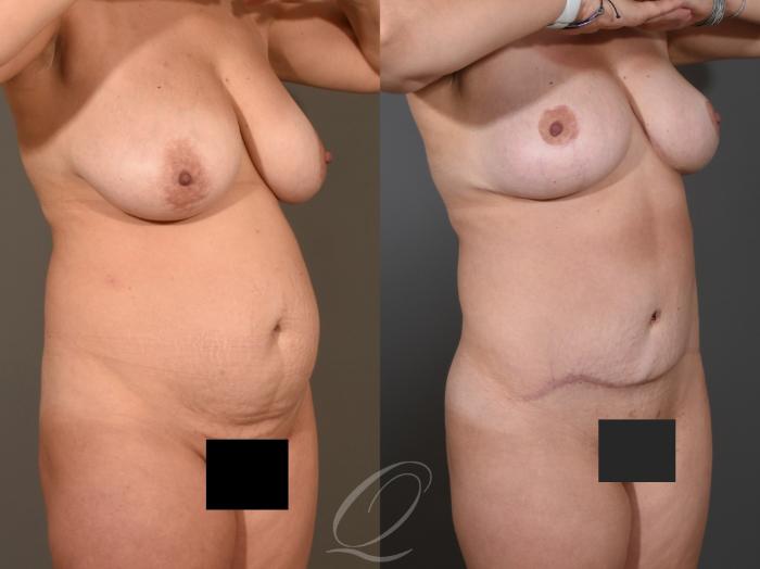 Tummy Tuck Case 395 Before & After Right Oblique | Serving Rochester, Syracuse & Buffalo, NY | Quatela Center for Plastic Surgery