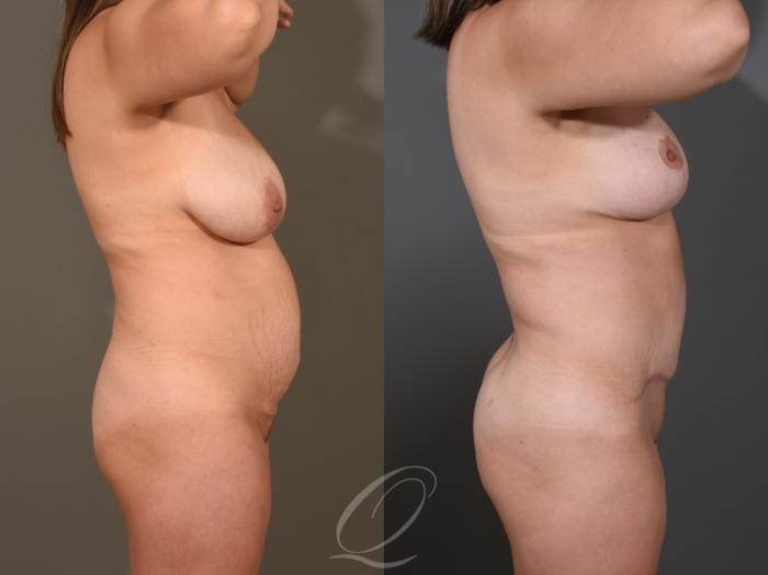 Mommy Makeover Case 395 Before & After Right Side | Serving Rochester, Syracuse & Buffalo, NY | Quatela Center for Plastic Surgery