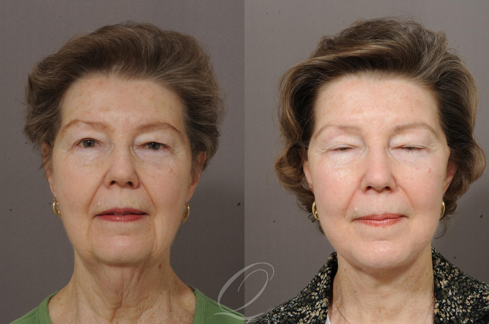 Neck Liposuction Case 199 Before & After View #1 | Serving Rochester, Syracuse & Buffalo, NY | Quatela Center for Plastic Surgery