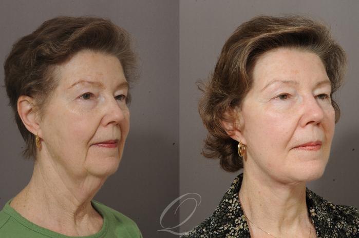 Neck Liposuction Case 199 Before & After View #2 | Serving Rochester, Syracuse & Buffalo, NY | Quatela Center for Plastic Surgery