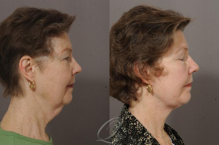 Neck Liposuction Case 199 Before & After View #3 | Serving Rochester, Syracuse & Buffalo, NY | Quatela Center for Plastic Surgery