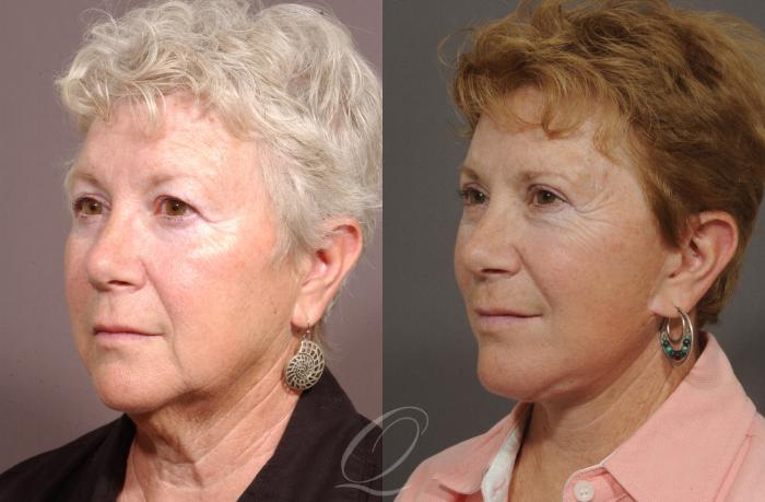 Neck Liposuction Case 78 Before & After View #2 | Serving Rochester, Syracuse & Buffalo, NY | Quatela Center for Plastic Surgery