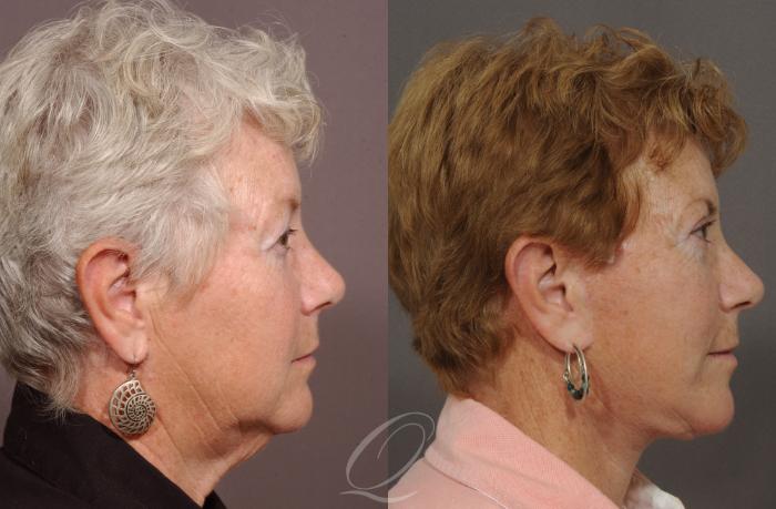 Neck Liposuction Case 78 Before & After View #3 | Serving Rochester, Syracuse & Buffalo, NY | Quatela Center for Plastic Surgery