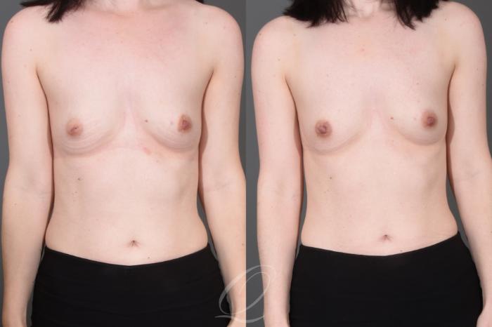 Nipple Procedures Case 1001662 Before & After Front | Serving Rochester, Syracuse & Buffalo, NY | Quatela Center for Plastic Surgery