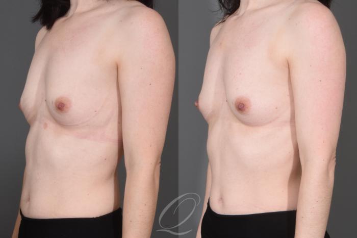 Nipple Procedures Case 1001662 Before & After Left Oblique | Serving Rochester, Syracuse & Buffalo, NY | Quatela Center for Plastic Surgery