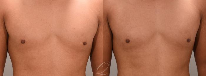 Nipple Procedures Case 1001663 Before & After Front Close-Up | Serving Rochester, Syracuse & Buffalo, NY | Quatela Center for Plastic Surgery