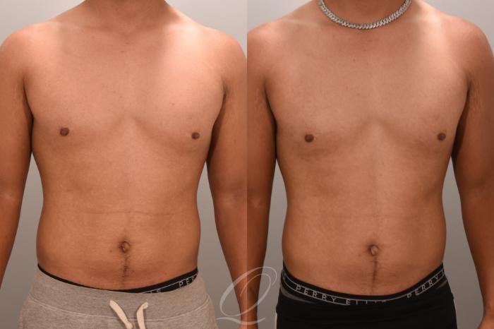 Nipple Procedures Case 1001663 Before & After Front | Serving Rochester, Syracuse & Buffalo, NY | Quatela Center for Plastic Surgery