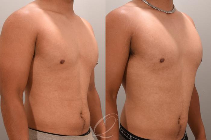 Nipple Procedures Case 1001663 Before & After Right Oblique | Serving Rochester, Syracuse & Buffalo, NY | Quatela Center for Plastic Surgery
