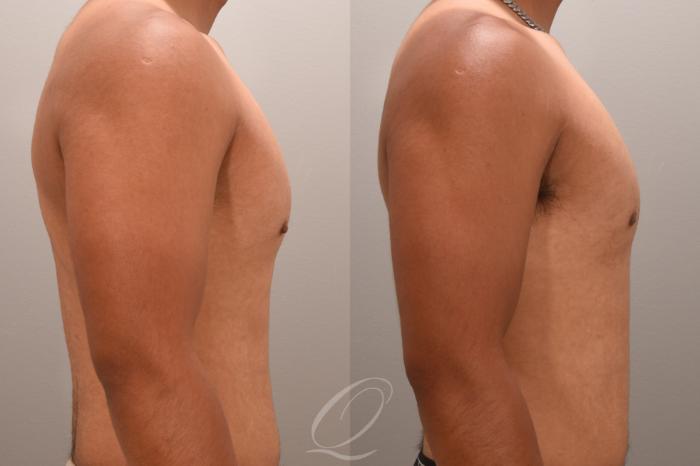 Nipple Procedures Case 1001663 Before & After Right Side | Serving Rochester, Syracuse & Buffalo, NY | Quatela Center for Plastic Surgery