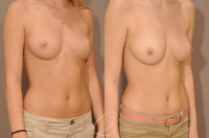 Nipple Procedures Case 1066 Before & After View #2 | Serving Rochester, Syracuse & Buffalo, NY | Quatela Center for Plastic Surgery
