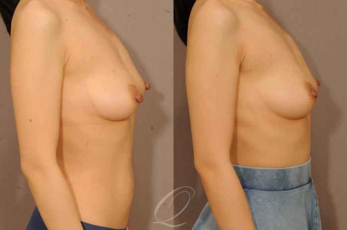 Nipple Procedures Case 1151 Before & After View #2 | Serving Rochester, Syracuse & Buffalo, NY | Quatela Center for Plastic Surgery