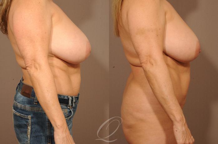 Nipple Procedures Case 1158 Before & After View #2 | Serving Rochester, Syracuse & Buffalo, NY | Quatela Center for Plastic Surgery