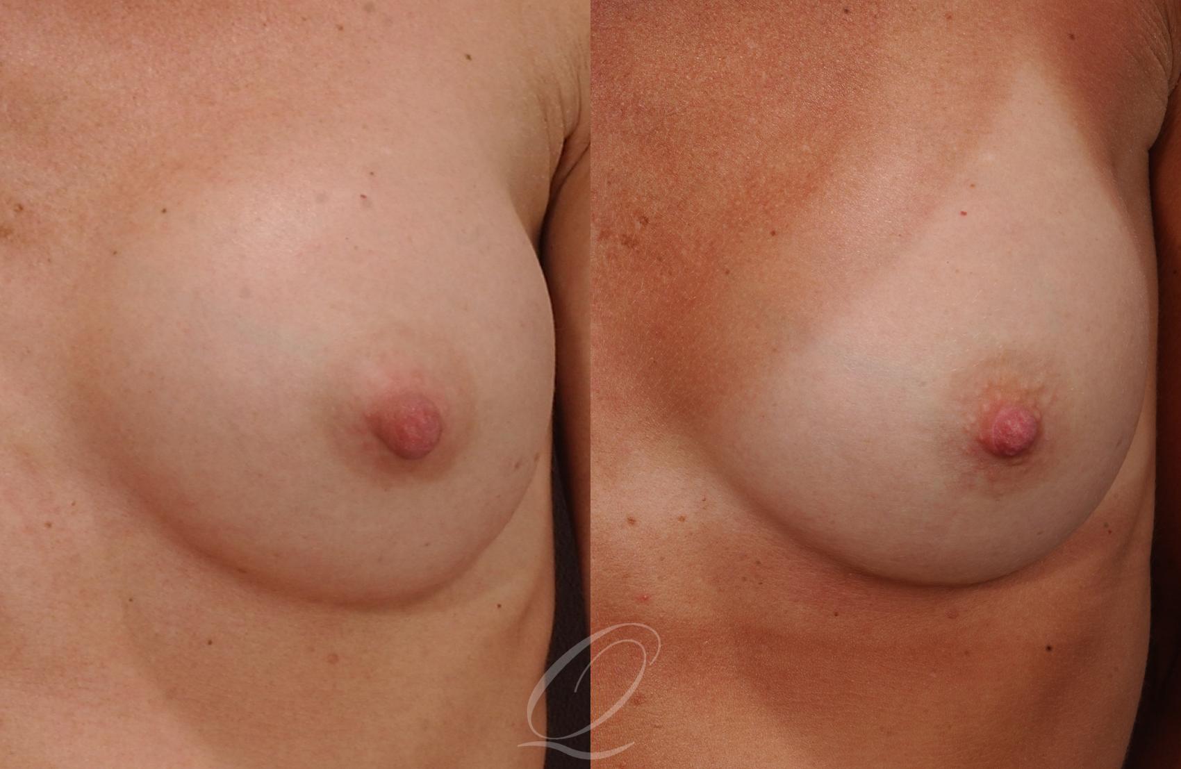 Nipple Procedures Case 195 Before & After View #1 | Serving Rochester, Syracuse & Buffalo, NY | Quatela Center for Plastic Surgery