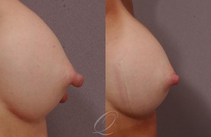 Nipple Procedures Case 195 Before & After View #2 | Serving Rochester, Syracuse & Buffalo, NY | Quatela Center for Plastic Surgery