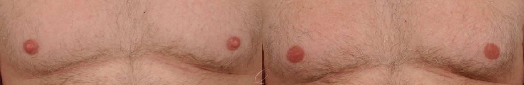 Nipple Procedures Case 196 Before & After View #1 | Serving Rochester, Syracuse & Buffalo, NY | Quatela Center for Plastic Surgery