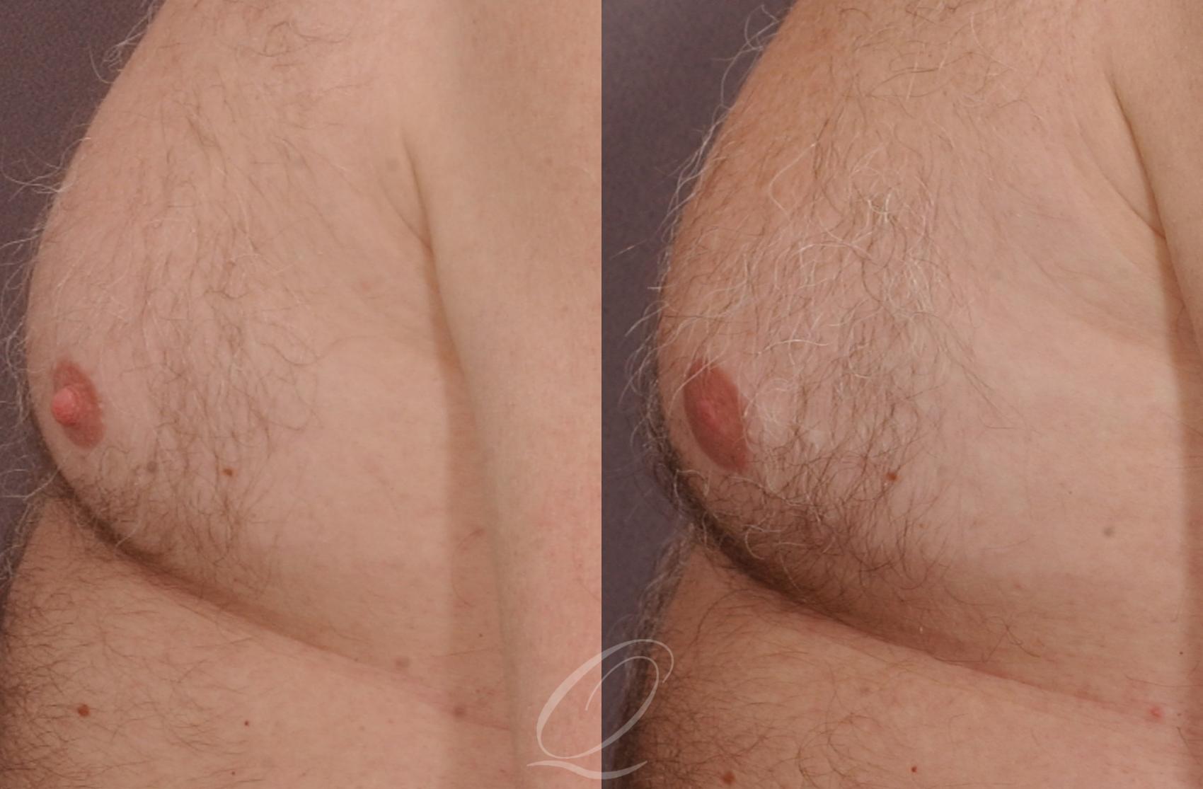 Nipple Procedures Case 196 Before & After View #2 | Serving Rochester, Syracuse & Buffalo, NY | Quatela Center for Plastic Surgery