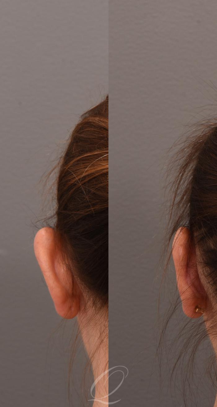 Otoplasty (Ear Pinning) Case 1001585 Before & After Back left | Serving Rochester, Syracuse & Buffalo, NY | Quatela Center for Plastic Surgery