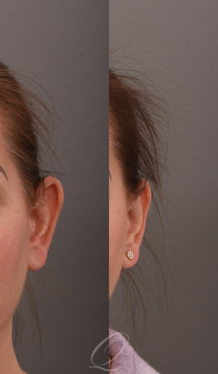 Otoplasty (Ear Pinning) Case 1001585 Before & After Left Side | Serving Rochester, Syracuse & Buffalo, NY | Quatela Center for Plastic Surgery