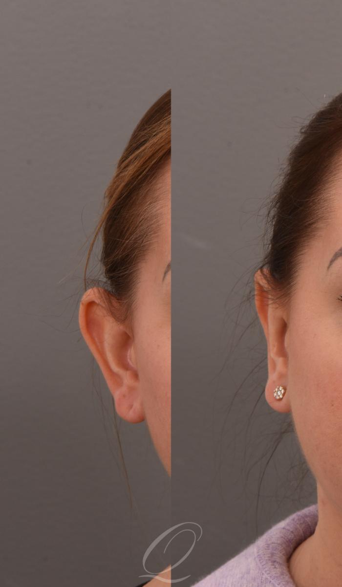 Otoplasty (Ear Pinning) Case 1001585 Before & After Right Side | Serving Rochester, Syracuse & Buffalo, NY | Quatela Center for Plastic Surgery