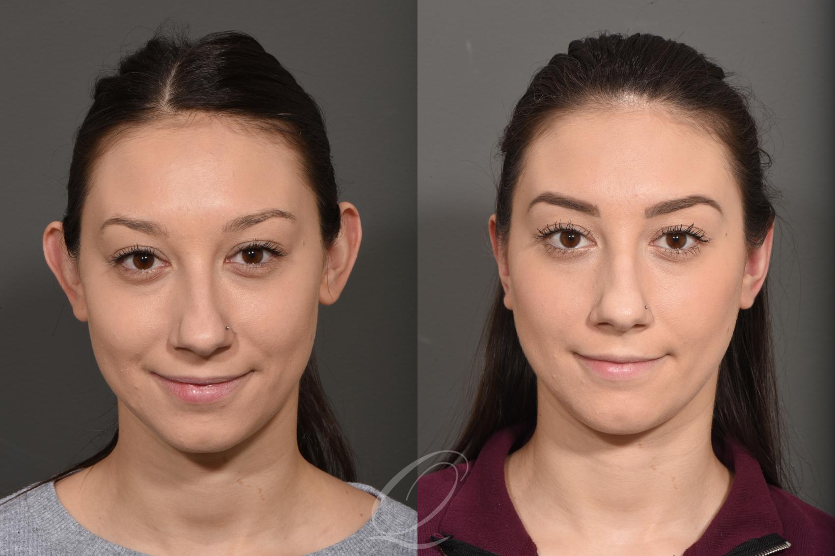 Otoplasty (Ear Pinning) Case 355 Before & After View #1 | Serving Rochester, Syracuse & Buffalo, NY | Quatela Center for Plastic Surgery