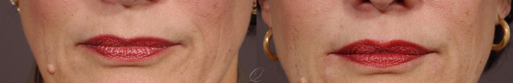 Perlane® Case 216 Before & After View #1 | Serving Rochester, Syracuse & Buffalo, NY | Quatela Center for Plastic Surgery