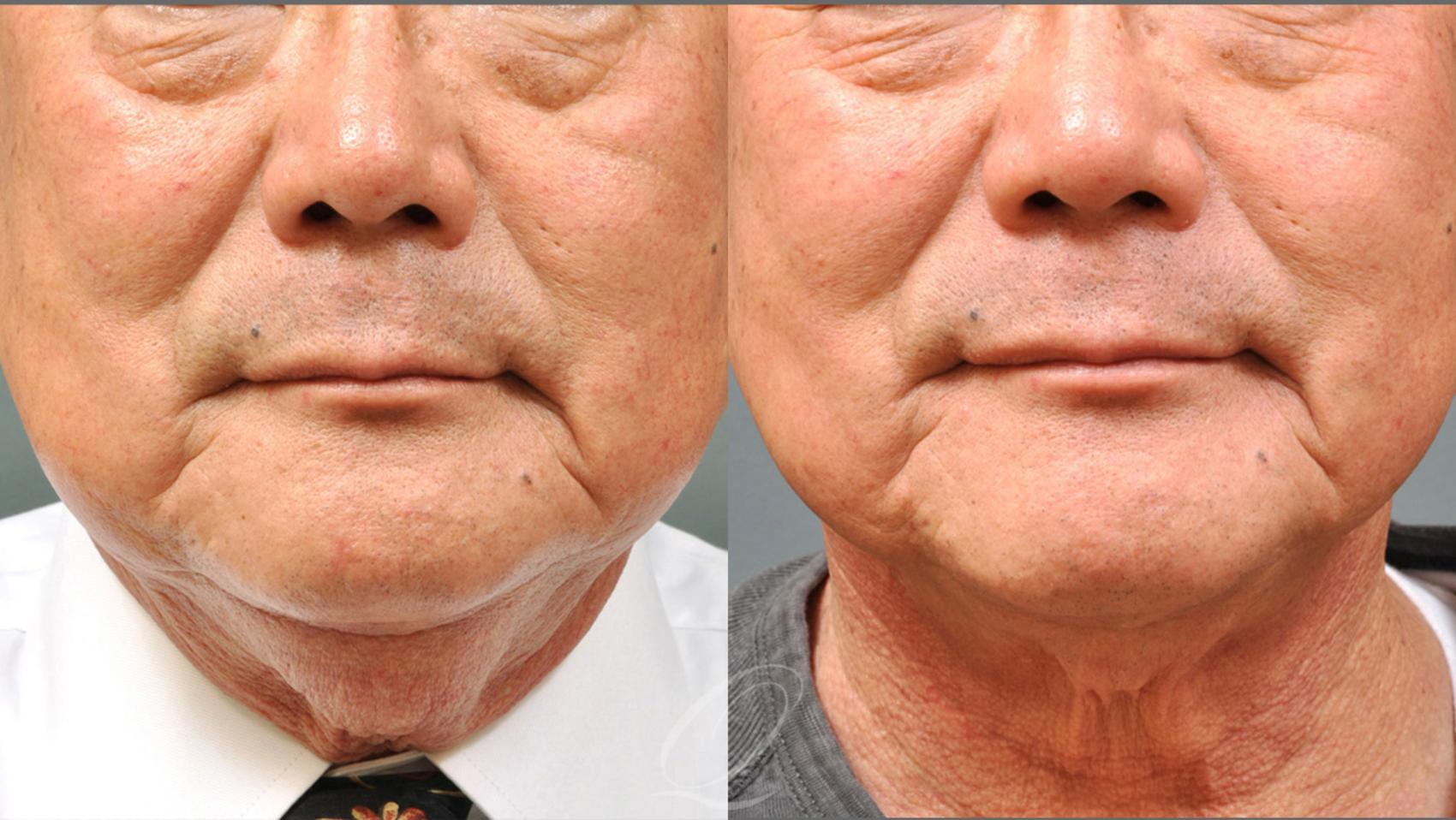 PrecisionTx for Facial Contouring Case 238 Before & After View #1 | Serving Rochester, Syracuse & Buffalo, NY | Quatela Center for Plastic Surgery
