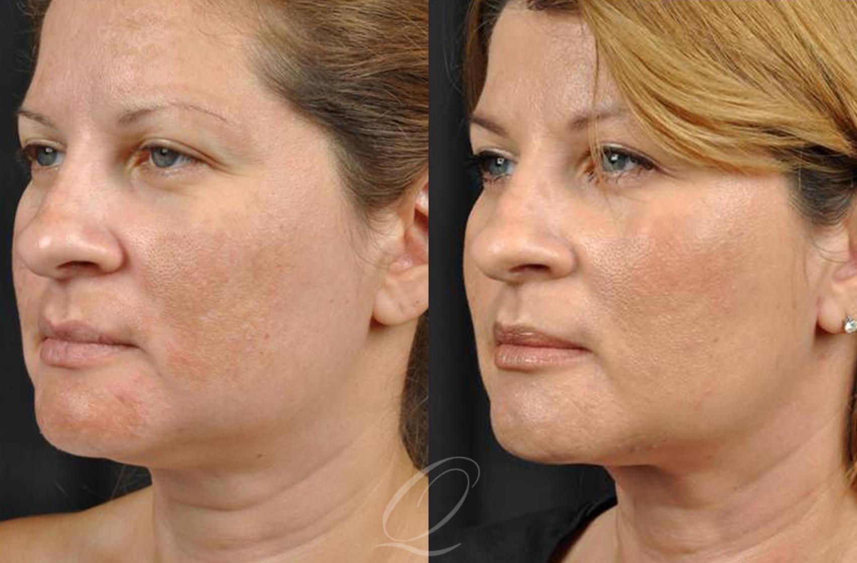 PrecisionTx for Facial Contouring Case 239 Before & After View #1 | Serving Rochester, Syracuse & Buffalo, NY | Quatela Center for Plastic Surgery