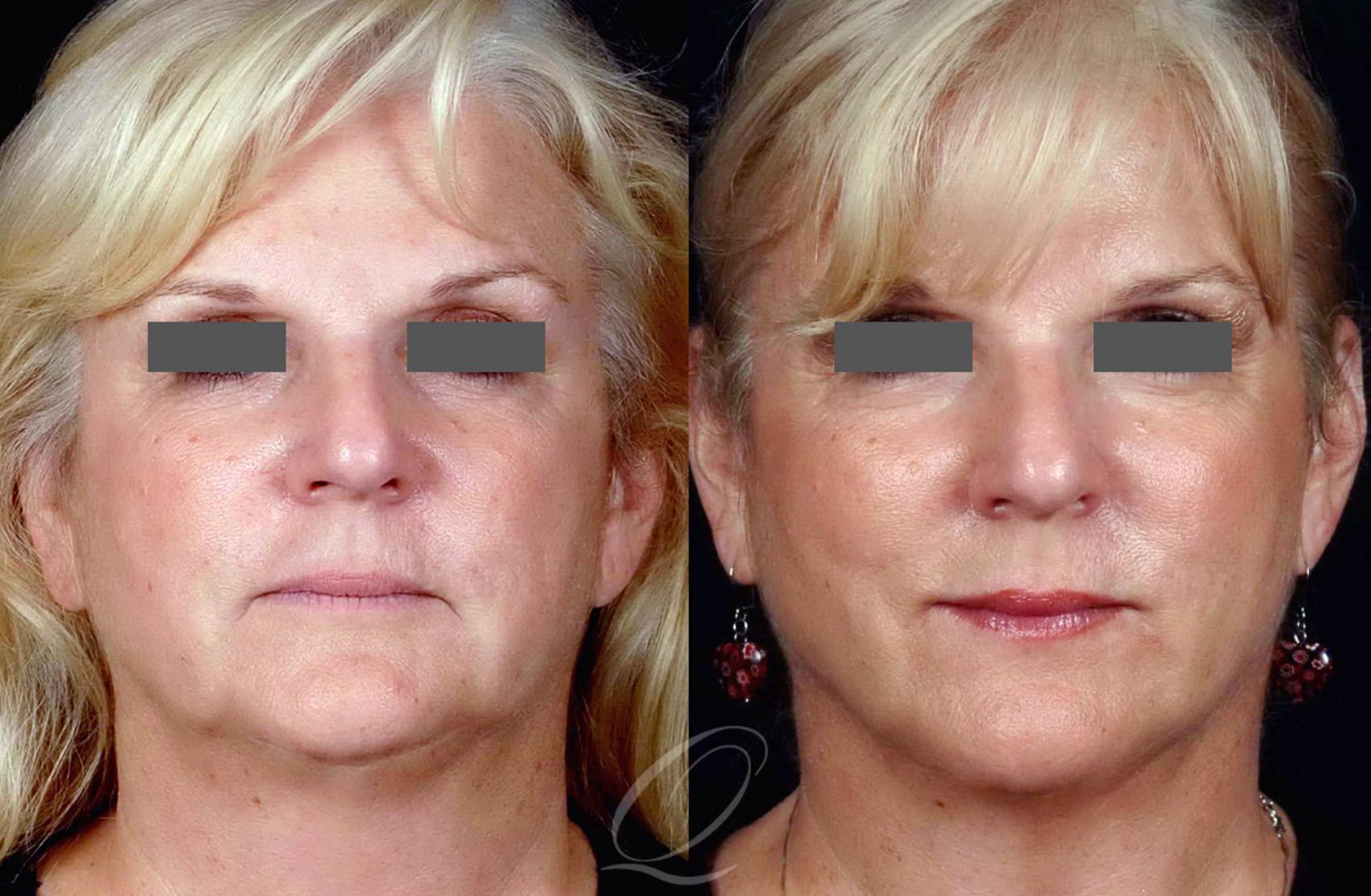 PrecisionTx for Facial Contouring Case 241 Before & After View #1 | Serving Rochester, Syracuse & Buffalo, NY | Quatela Center for Plastic Surgery