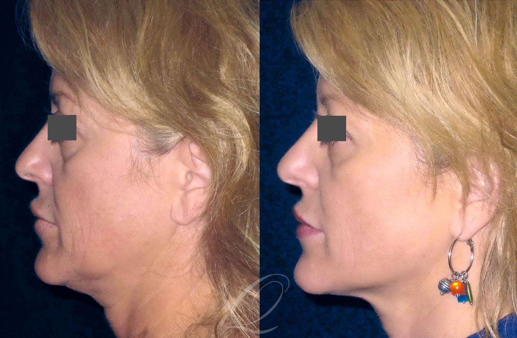 PrecisionTx for Facial Contouring Case 242 Before & After View #1 | Serving Rochester, Syracuse & Buffalo, NY | Quatela Center for Plastic Surgery