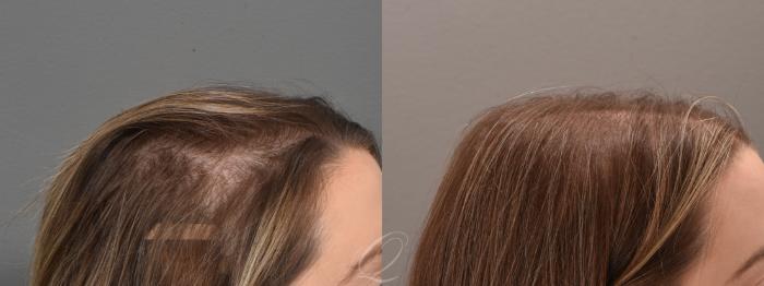 PRP Injections Case 1001694 Before & After Right Side | Serving Rochester, Syracuse & Buffalo, NY | Quatela Center for Plastic Surgery