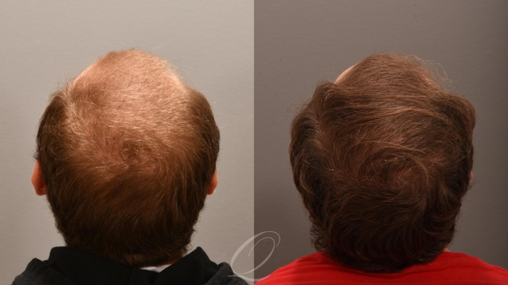 PRP Injections Case 1001848 Before & After Back | Serving Rochester, Syracuse & Buffalo, NY | Quatela Center for Plastic Surgery