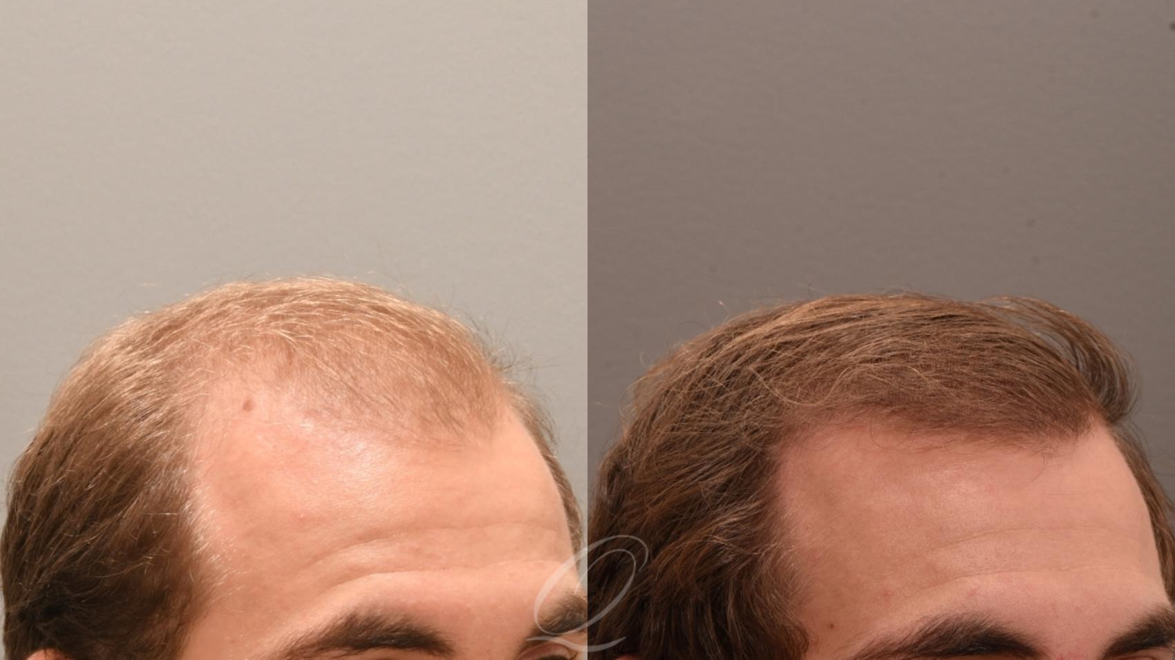 PRP Injections Case 1001848 Before & After Left Side | Serving Rochester, Syracuse & Buffalo, NY | Quatela Center for Plastic Surgery