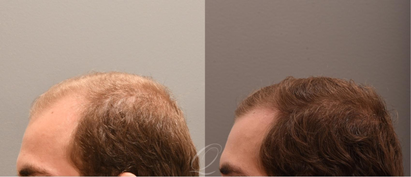 PRP Injections Case 1001848 Before & After Right Oblique | Serving Rochester, Syracuse & Buffalo, NY | Quatela Center for Plastic Surgery