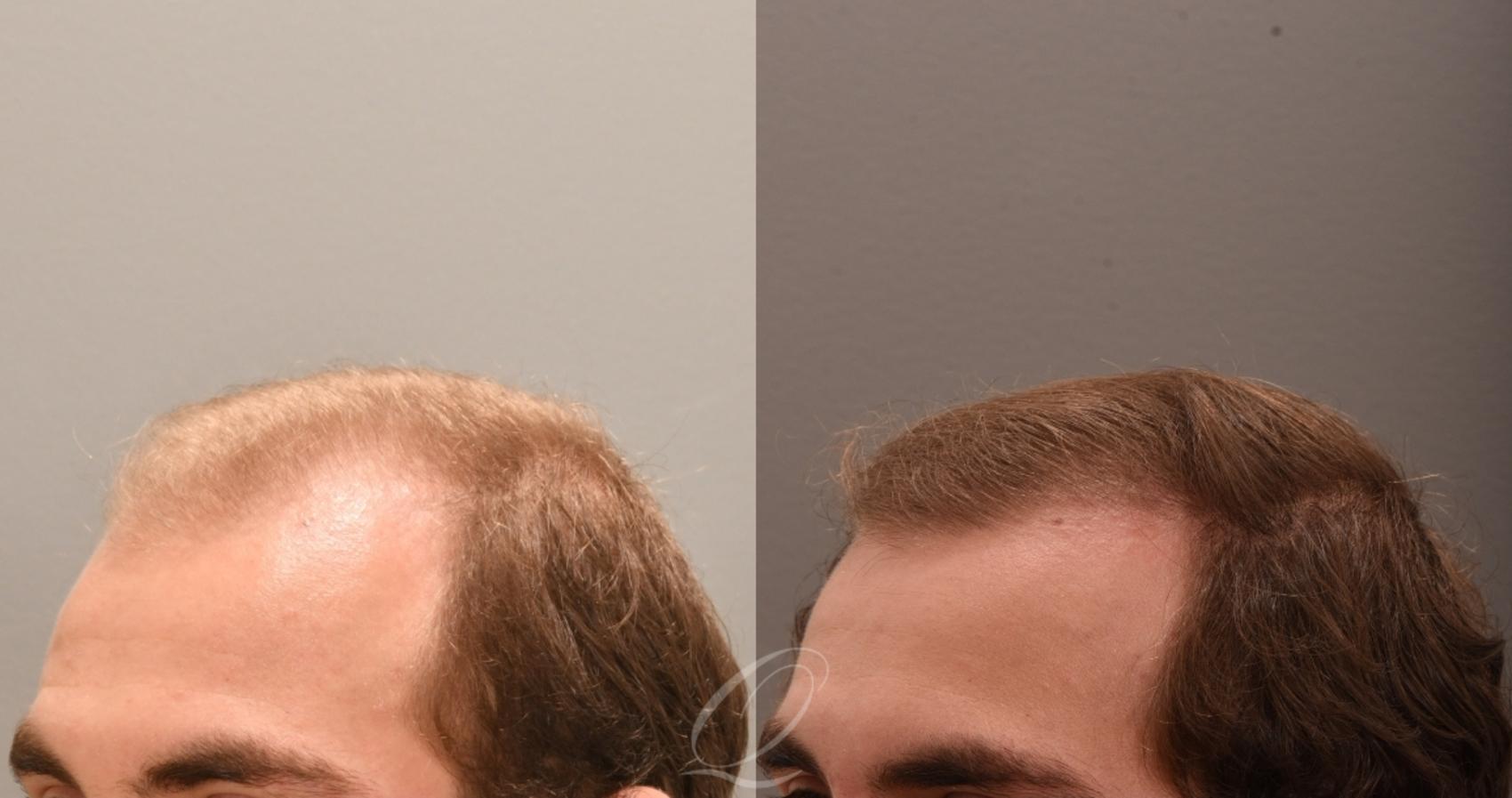 PRP Injections Case 1001848 Before & After Right Side | Serving Rochester, Syracuse & Buffalo, NY | Quatela Center for Plastic Surgery