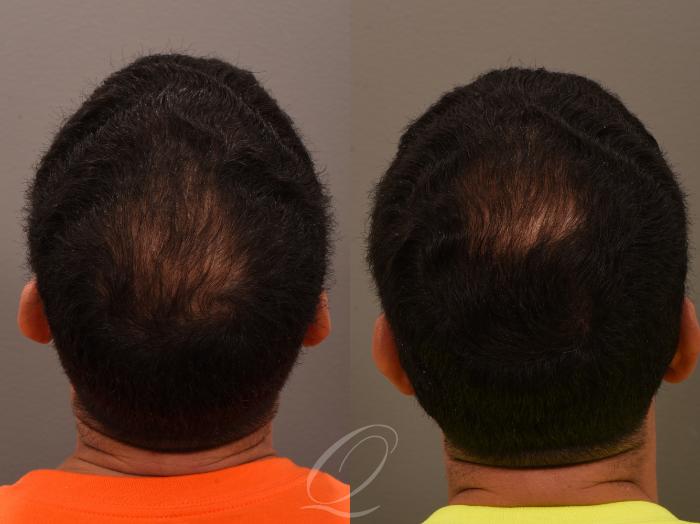 PRP Injections Case 1001870 Before & After Back | Serving Rochester, Syracuse & Buffalo, NY | Quatela Center for Plastic Surgery