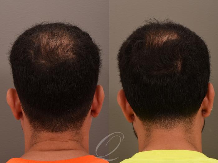 PRP Injections Case 1001870 Before & After Left Side | Serving Rochester, Syracuse & Buffalo, NY | Quatela Center for Plastic Surgery