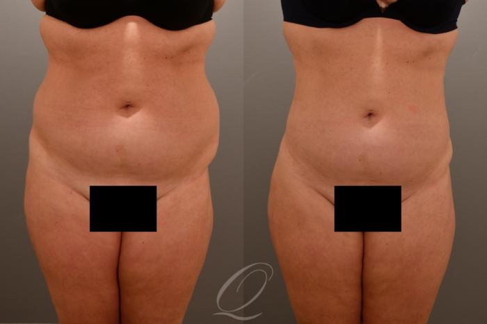Liposuction Case 1001669 Before & After Front | Serving Rochester, Syracuse & Buffalo, NY | Quatela Center for Plastic Surgery
